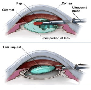 cataract surgery