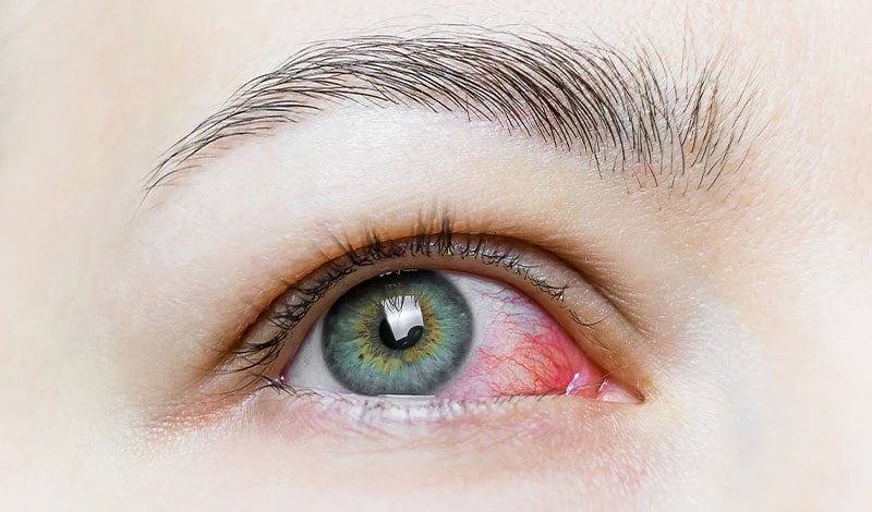 Are ICLs Suitable for Patients With Dry Eyes?