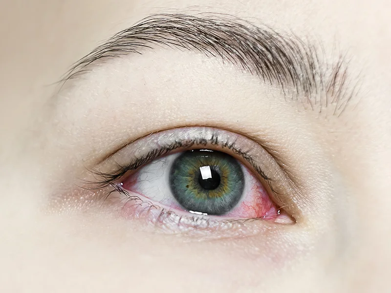 dry eye assessment