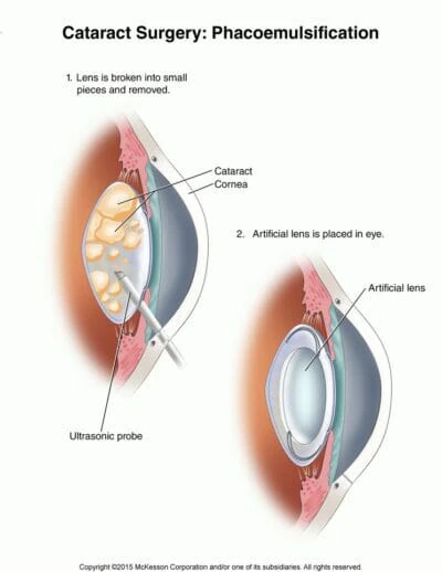 Cataract Surgery: Phacoemulsification