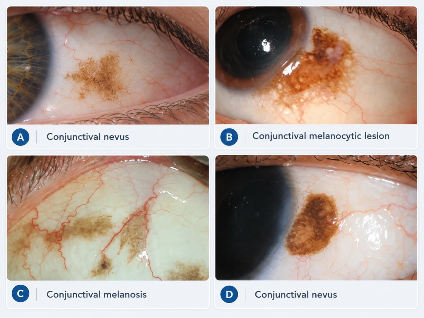 Four clinical photographs of benign pigmented conjunctival lesions