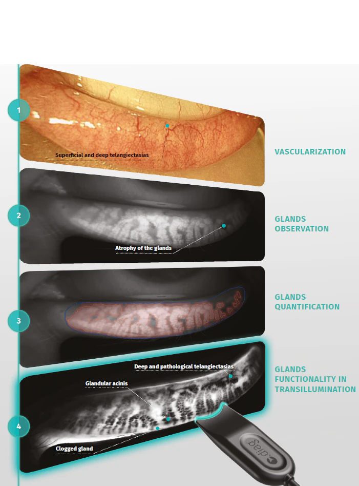 dry eye assessment