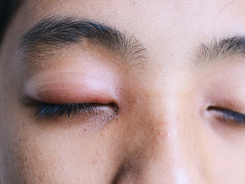 styes