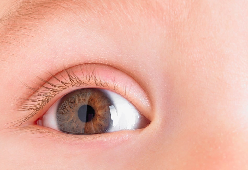 Congenital Corneal Disease