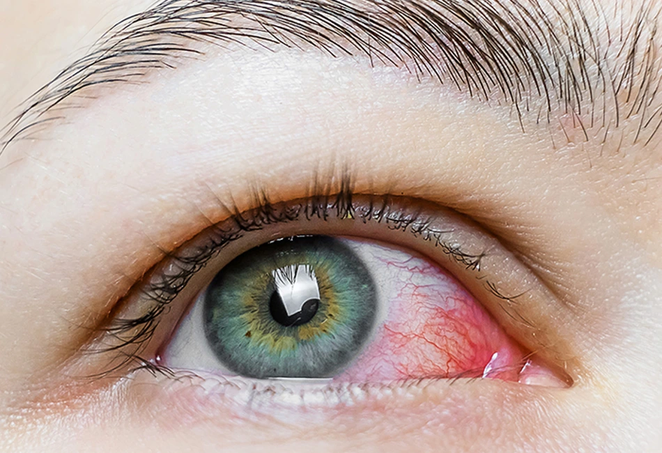 dry eye