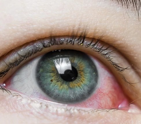 Close-up of an eye showing conjunctival redness