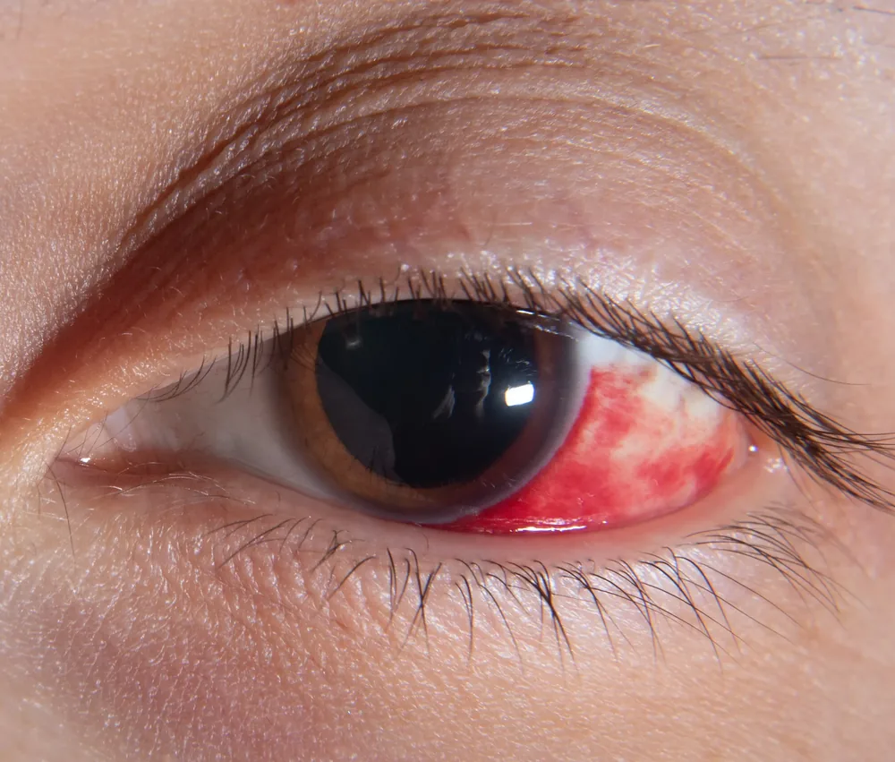 Close-up of an eye with surface irritation
