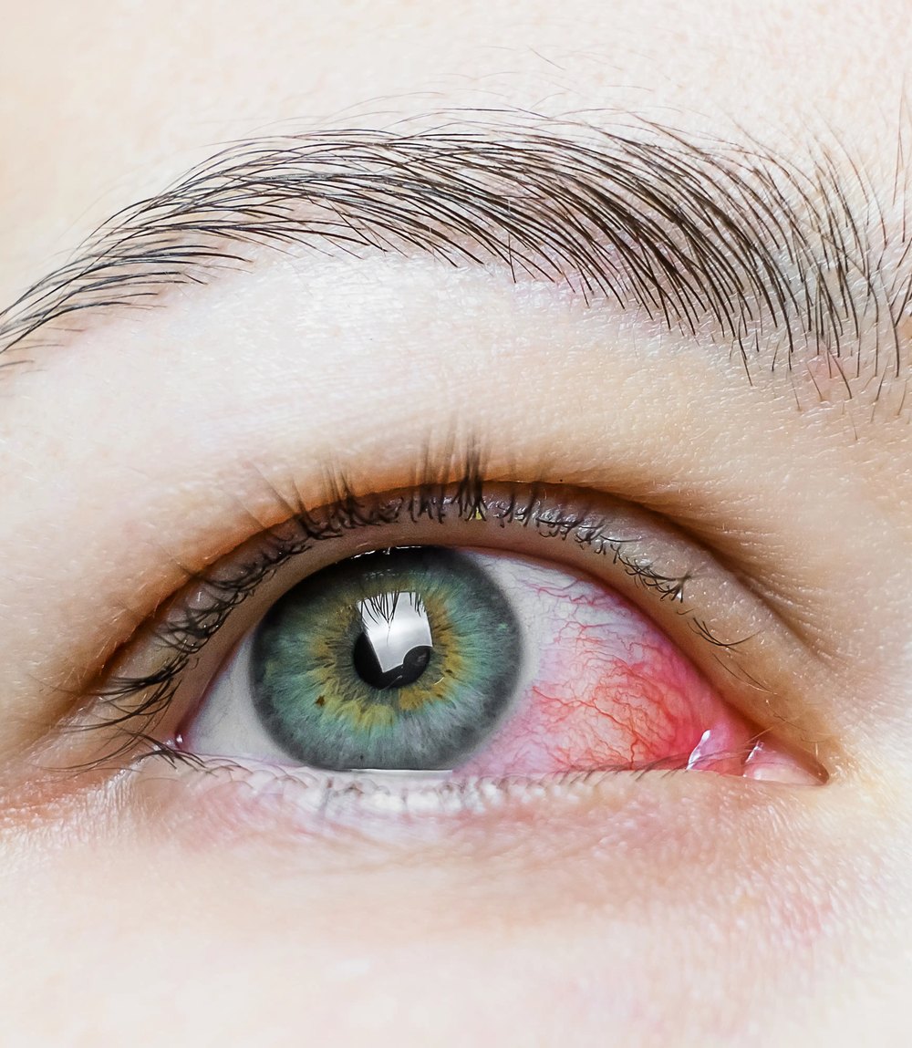 Close-up of an irritated ocular surface
