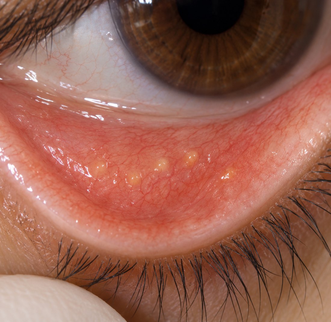 Lower eyelid turning outward in ectropion