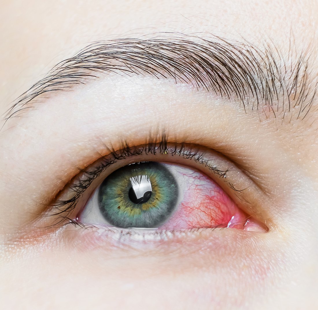 Irritated lower eyelid with small benign lesions