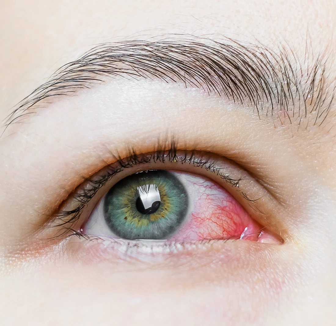 Irritated lower eyelid with small benign lesions
